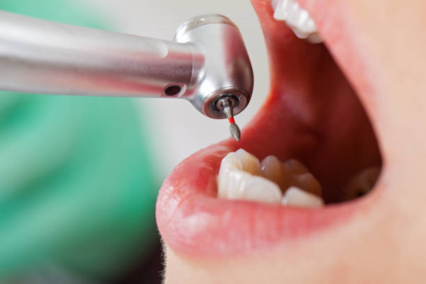 Best Knocked-Out Tooth (Avulsed Tooth) Treatment in Difficult Run, VA